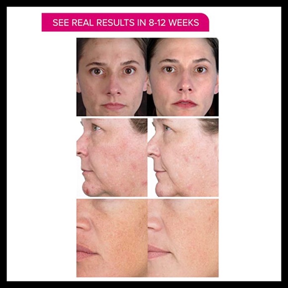 PMD Personal Microderm Skin Renewal System - Picture 4 of 8